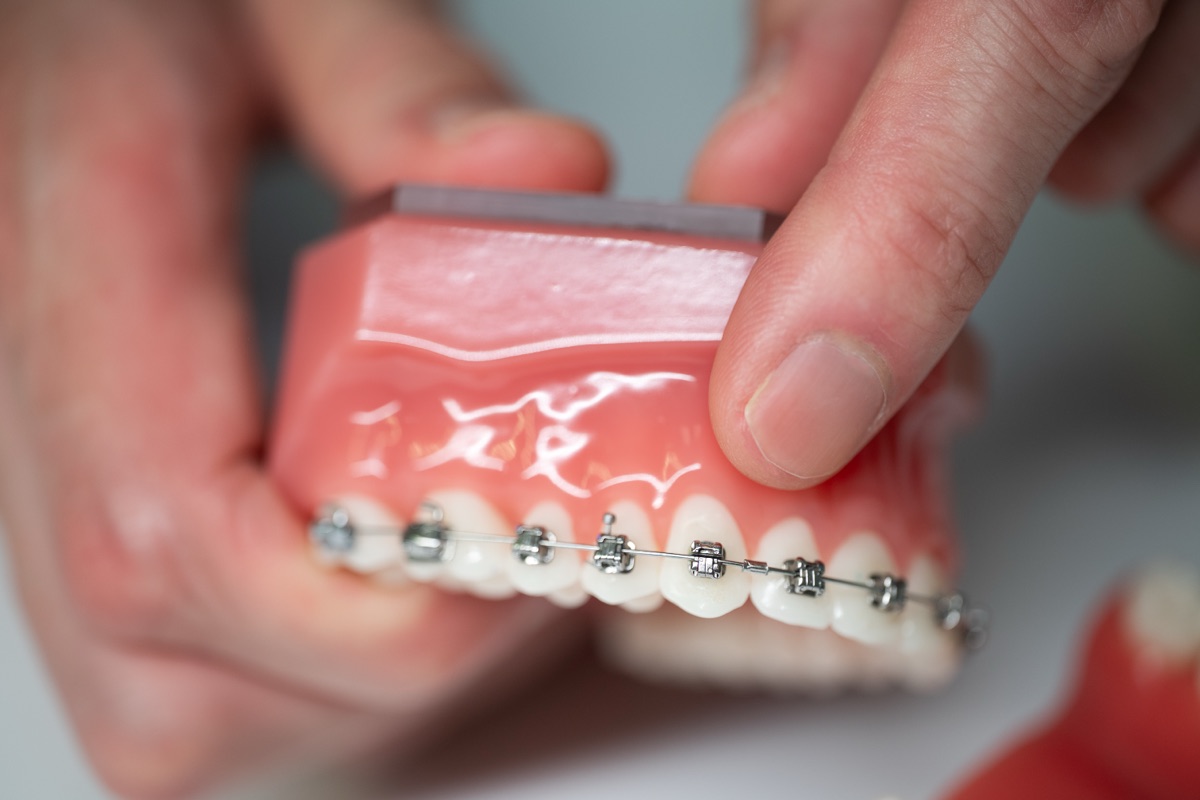 Close up of Damon braces on a model of the lower teeth