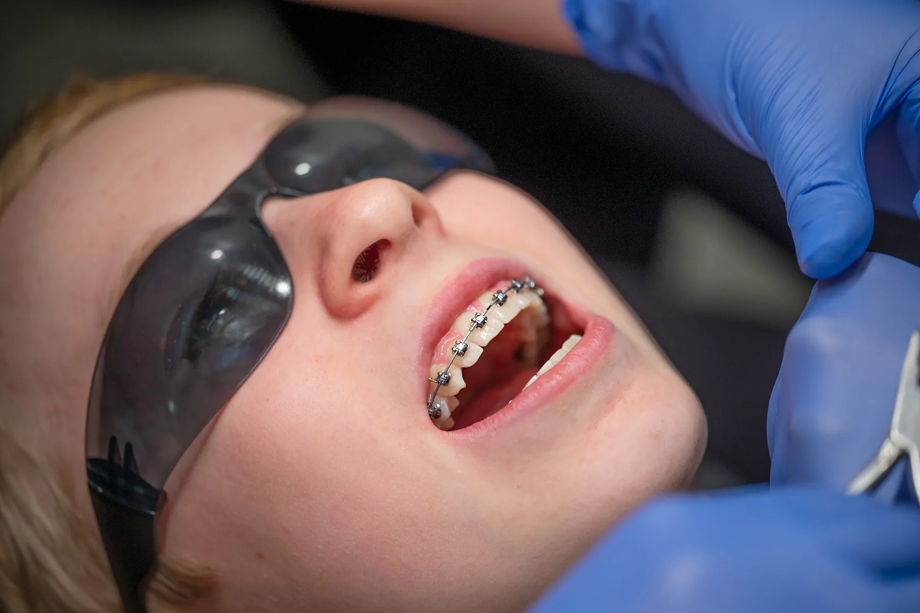 Damon Braces