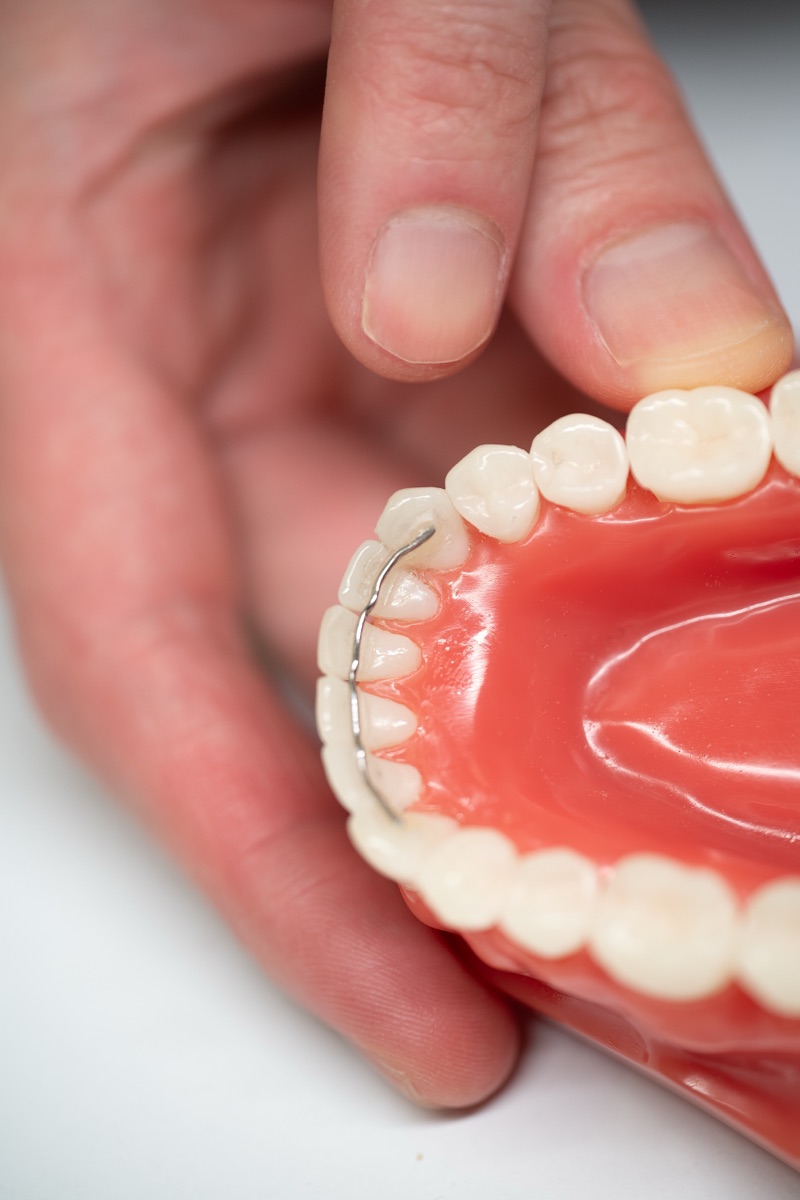 Close-up of a fixed wire retainer behind the lower front teeth