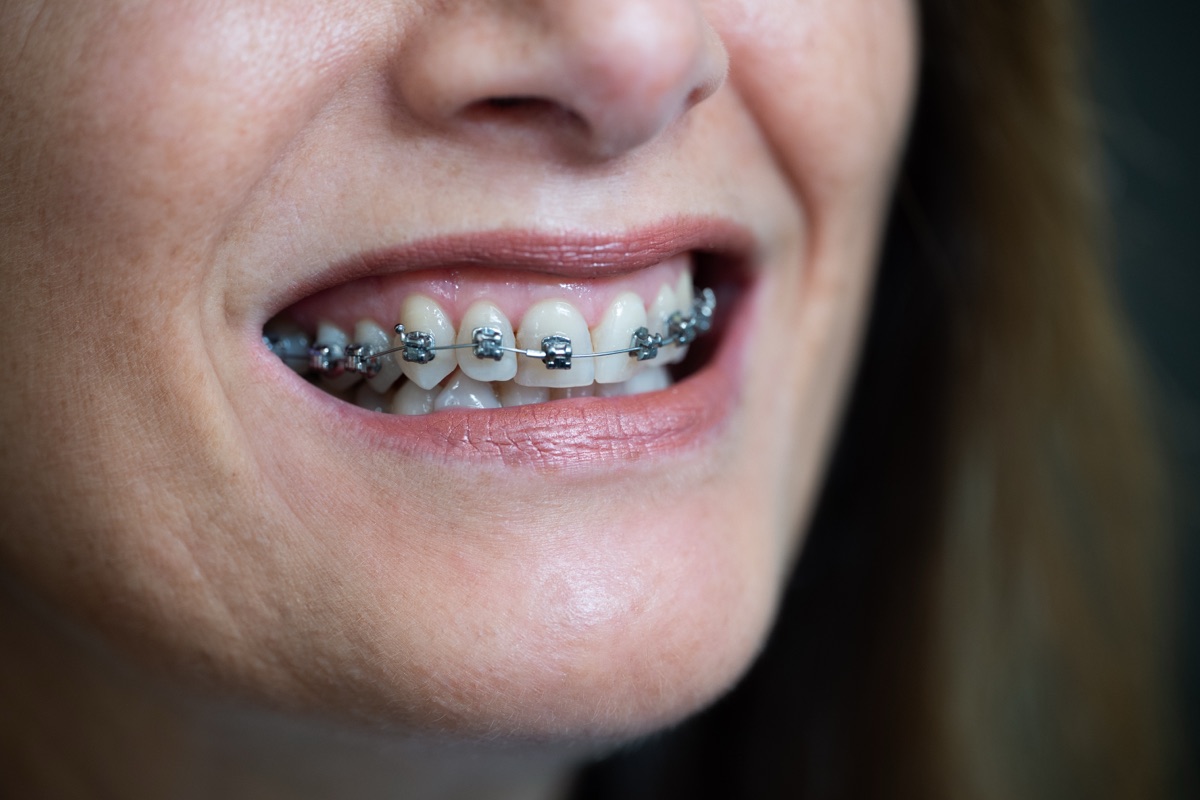 Surgical Orthodontics