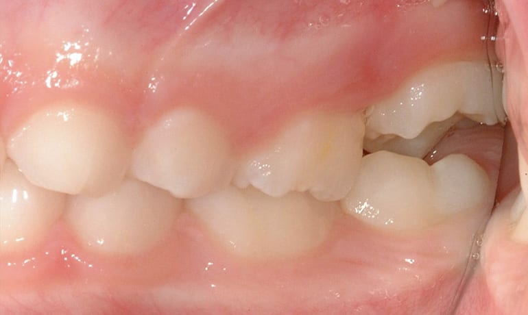 Ectopic First Molars after treatment