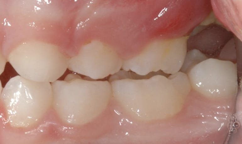 Ectopic First Molars before treatment