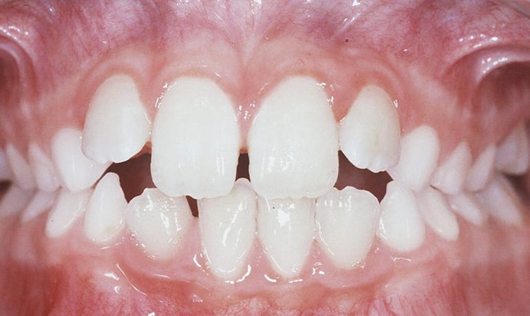 Thumb Sucking Habit after treatment