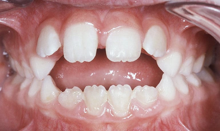 Thumb Sucking Habit before treatment