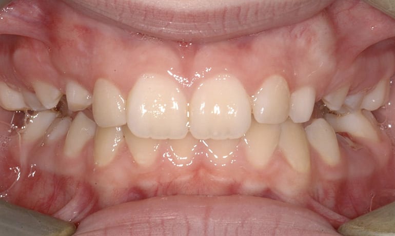 Posterior Crossbite after treatment