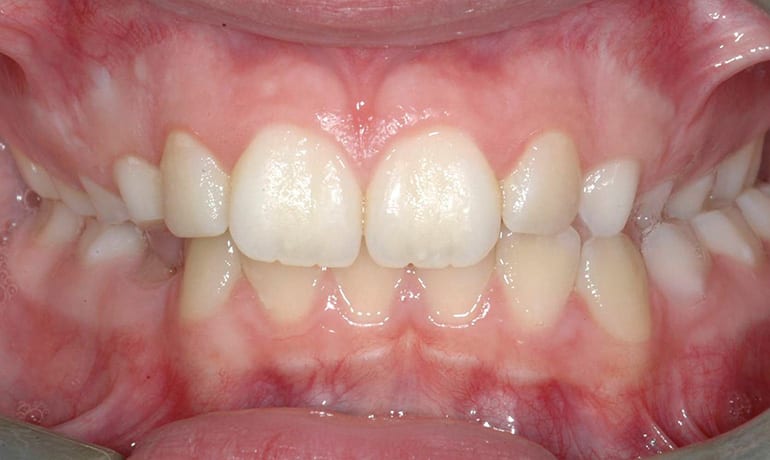 Posterior Crossbite before treatment