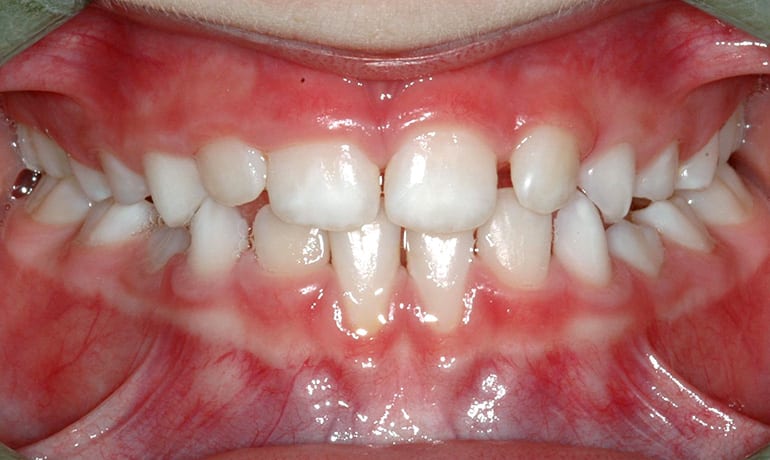 Anterior Crossbite after treatment