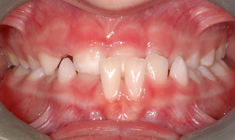Anterior Crossbite before treatment