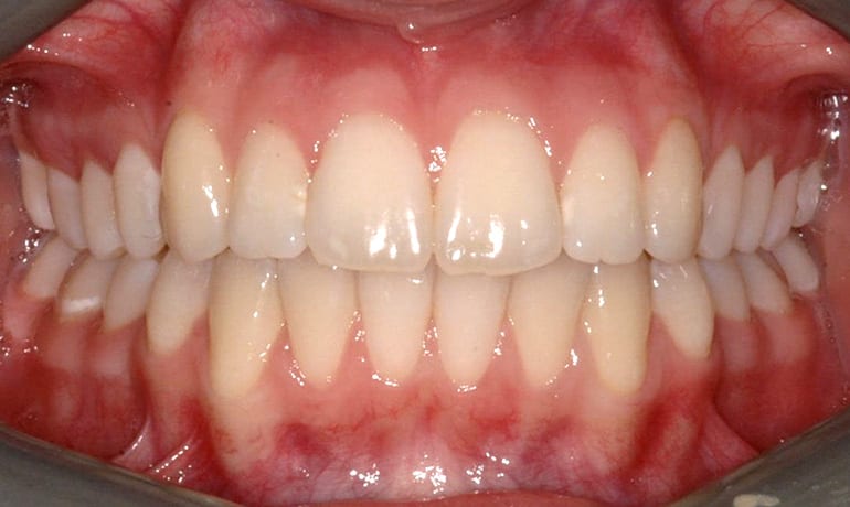 Crooked Teeth after treatment