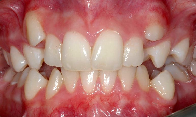 Crooked Teeth before treatment