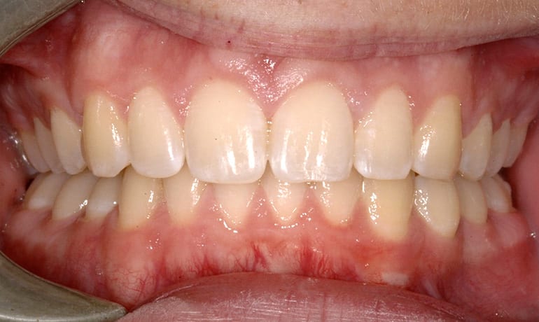 Deepbite after treatment