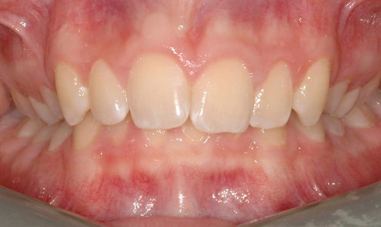 Deepbite before treatment