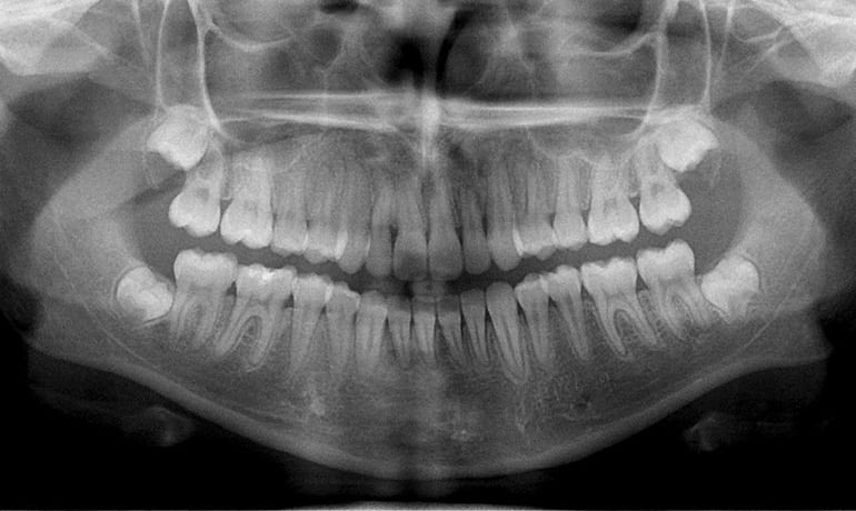 Impacted Teeth after treatment