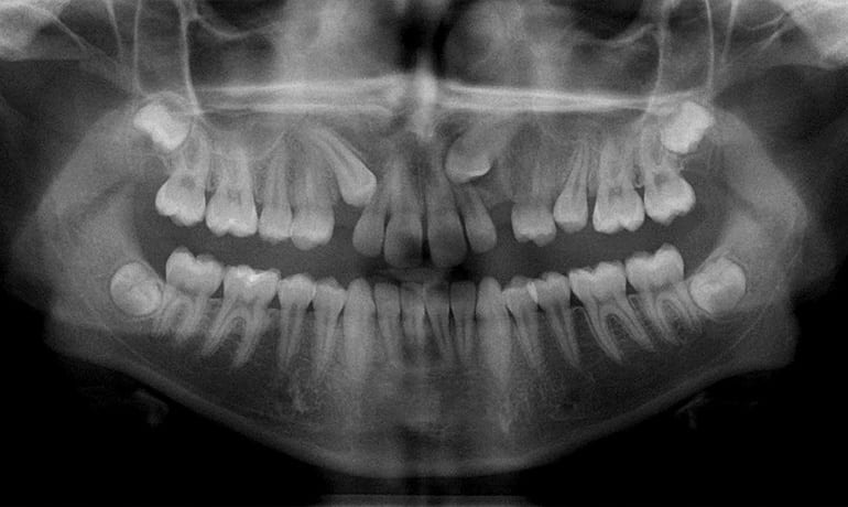 Impacted Teeth before treatment