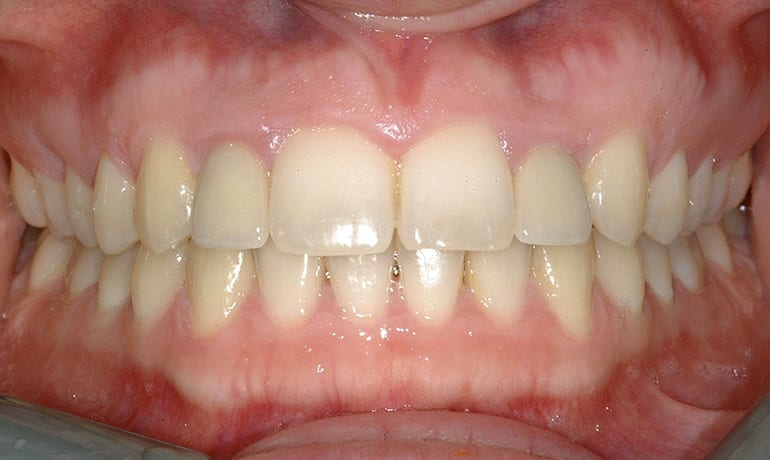 Missing Teeth after treatment
