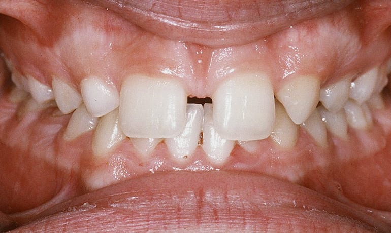 Missing Teeth before treatment