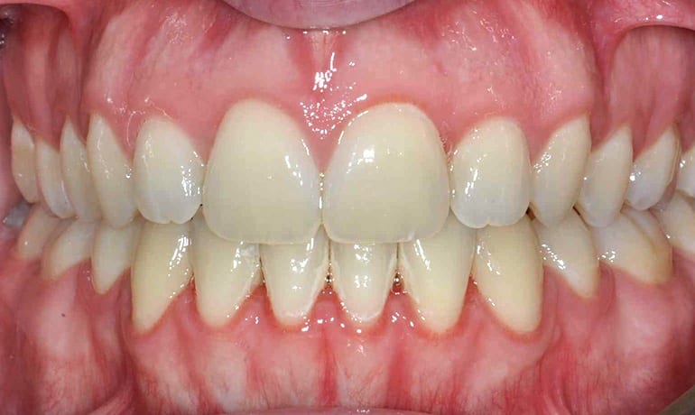 Openbite after treatment