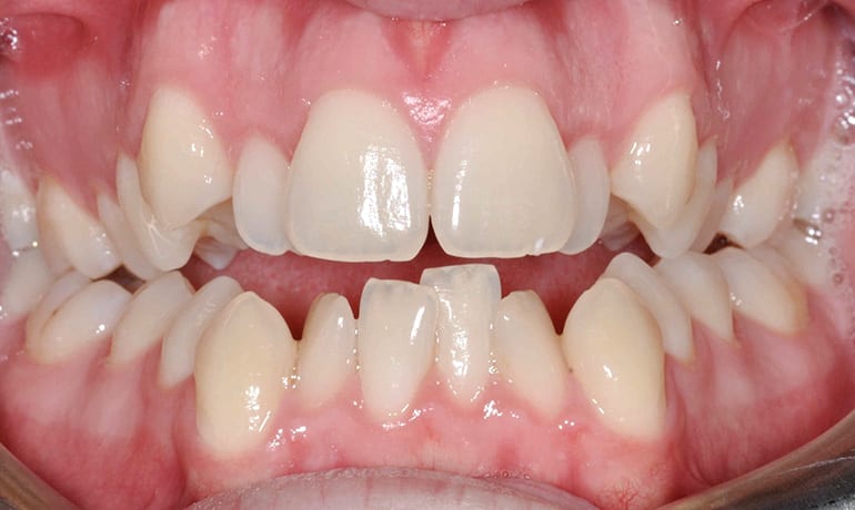 Openbite before treatment