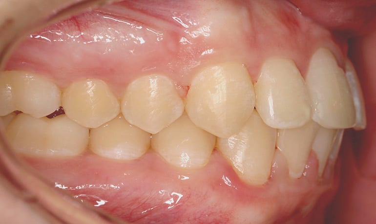 Protrusive Bite after treatment
