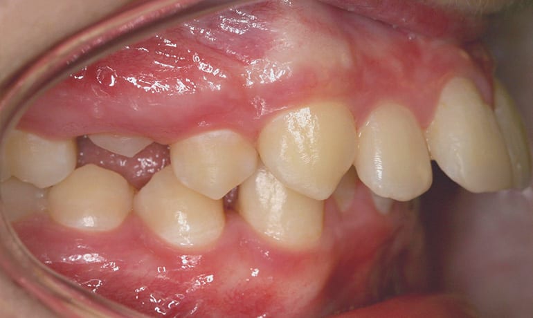 Protrusive Bite before treatment