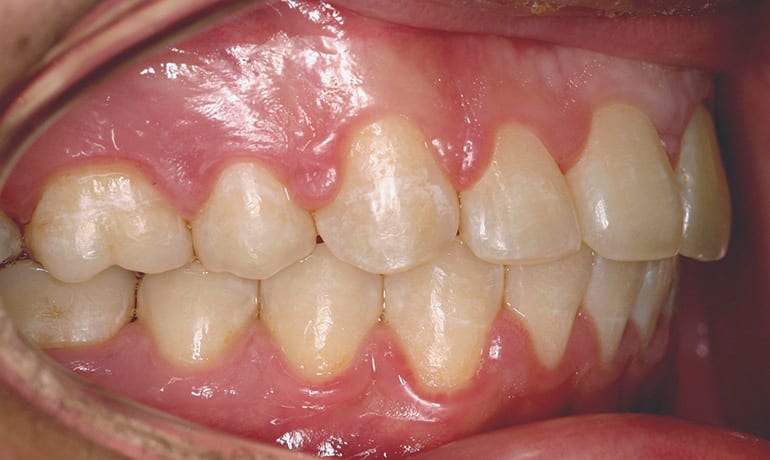 Protrusive Bite after treatment