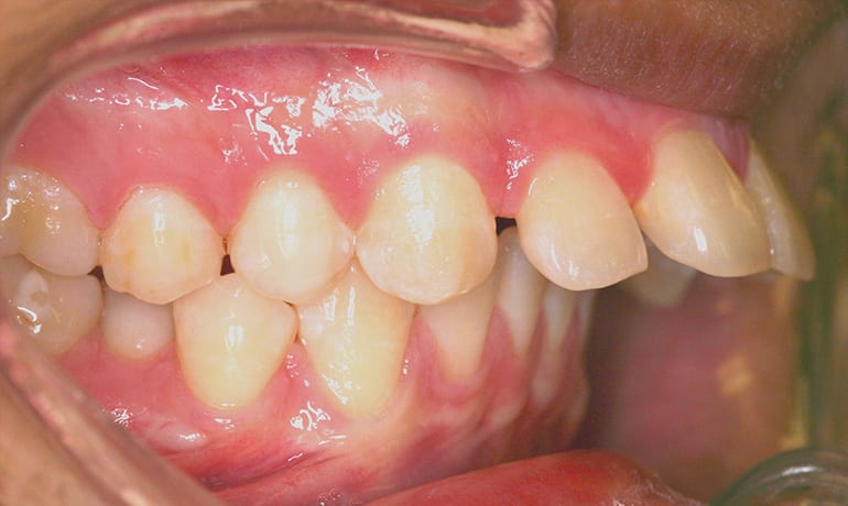 Protrusive Bite before treatment