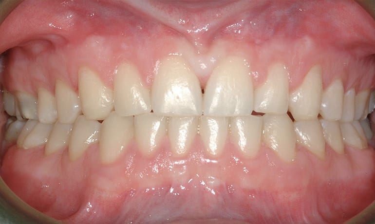 Spacing after treatment