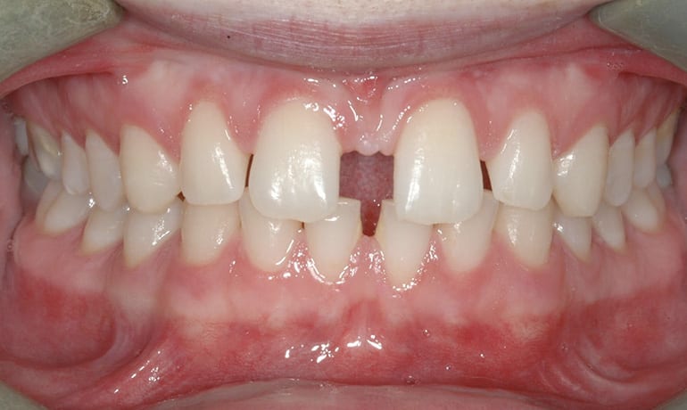 Spacing before treatment