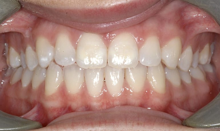 Invisalign® after treatment