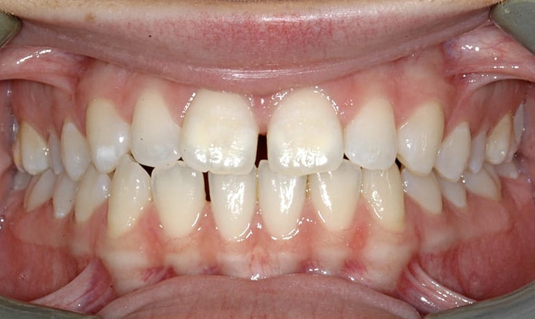 Invisalign® before treatment
