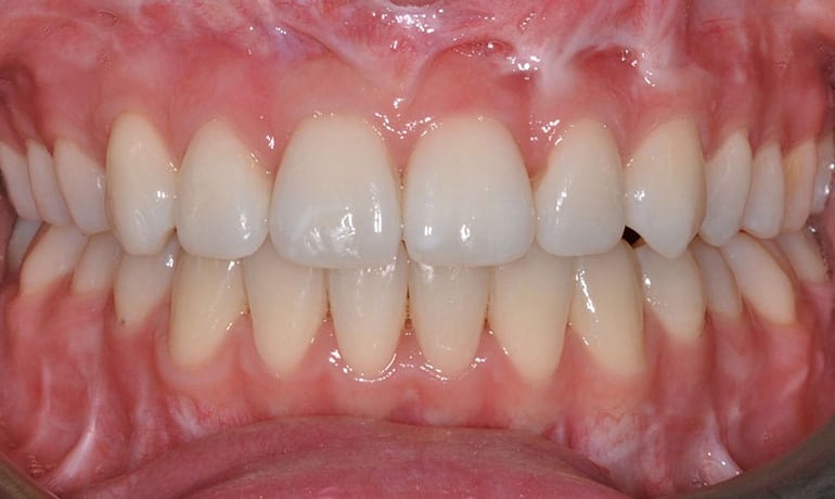 Skeletal Openbite after treatment