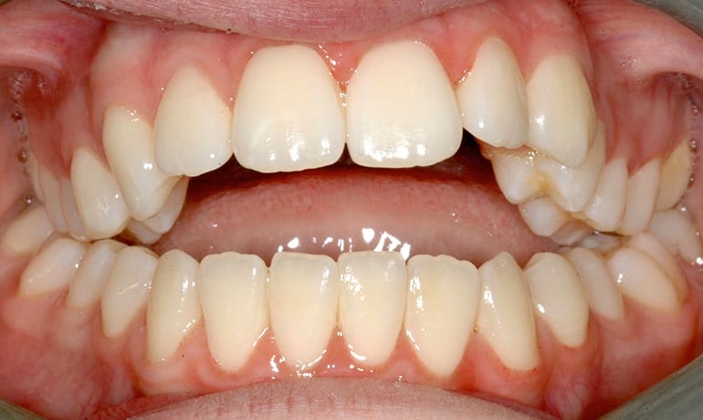 Skeletal Openbite before treatment