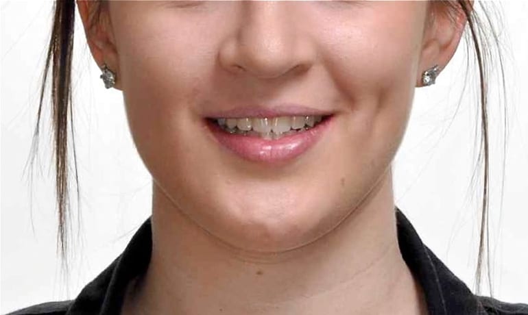 Excessive Gum Display after treatment
