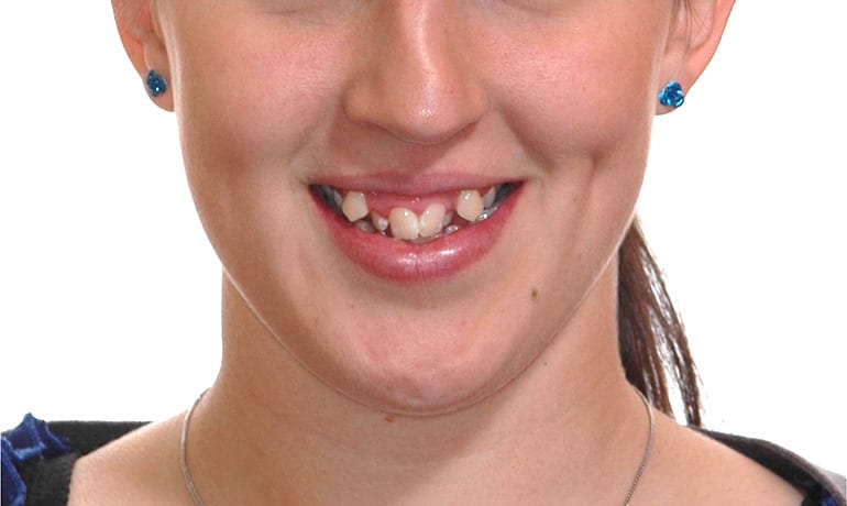 Excessive Gum Display before treatment