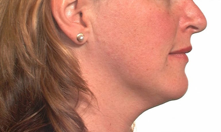 Retruded Lower Jaw after treatment