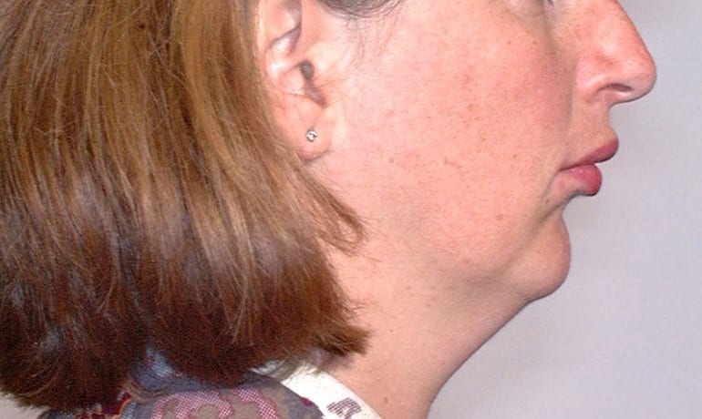 Retruded Lower Jaw before treatment